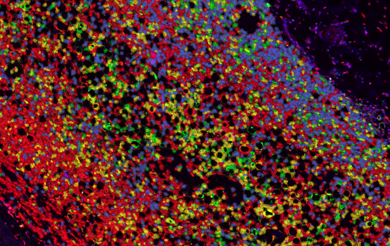 AI Pathology: Explore the tissue micro- environment with spatial data.